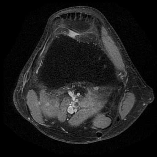 Figure 5 for case Third head of the gastrocnemius